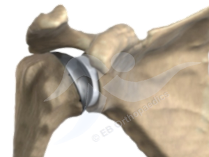 Physiotherapy shoulder arthroplasty leaflet